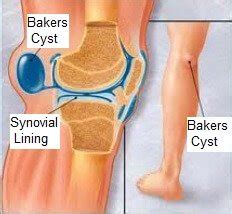 Popliteal Cyst (Baker's Cyst): Physiotherapy Treatment