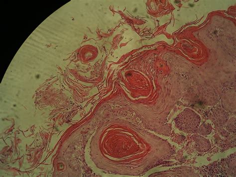 Squamous Cell Carcinoma – howMed