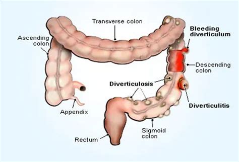 diverticulitis diverticulosis symptoms diet treatment