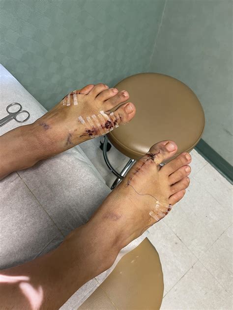 Asymptotic “end-stage” Hallux Rigidus: surgery vs dealing with it : bunions