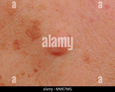 INTRADERMAL NEVUS Stock Photo - Alamy