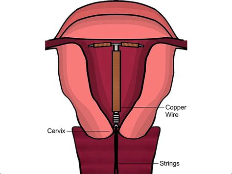 Paragard Iud Diagram 38 Copper Iud Stock Photos, High Res Pictures,