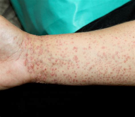 Lichen Planus – West Houston Dermatology