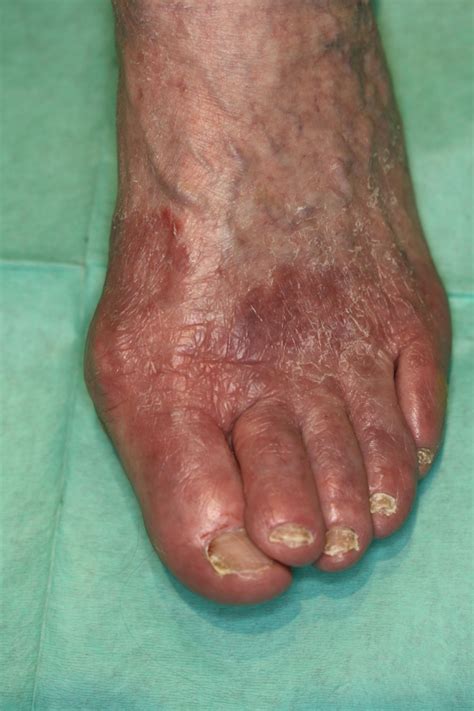 tinea pedis doccheck flexikon