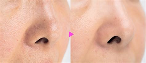 毛穴たるみ治す, 加齢による毛穴の広がり 改善方法 : 毛穴を引き締めるケア方法6選 – SPOYIK