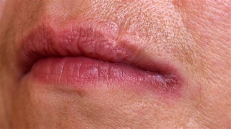 Angular cheilitis: Causes, symptoms, treatment
