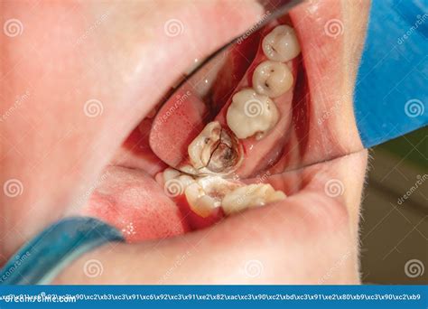 Close-up of a Fracture of a Human Molar Tooth Fracture. the Concept of ...