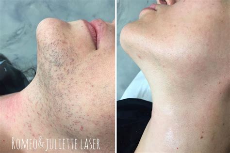pcos facial hair