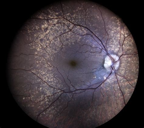 Autofluorescence Retina