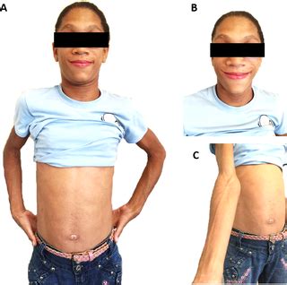 Lipodistrofia Congenita De Berardinelli Seip - Nurses' knowledge about Berardinelli-Seip Congenital Lipodystrophy ...