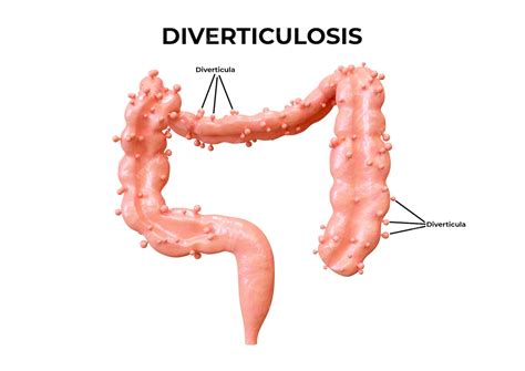 O Que São Divertículos - Diverticulose é um distúrbio gastrointestinal em que os divertículos se ...
