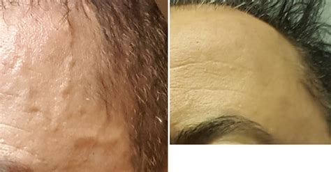 plastic surgery case study male temporal artery ligation  outcome