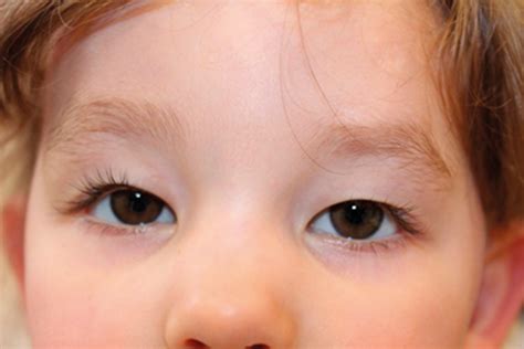Paediatric ptosis | Eye News