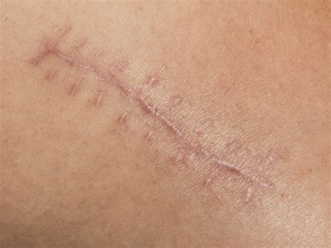 7 tips to speed up wound healing after plastic surgery| London