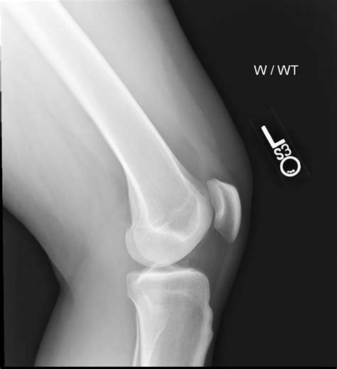Not just for boys: a rare case of symptomatic Osgood-Schlatter disease
