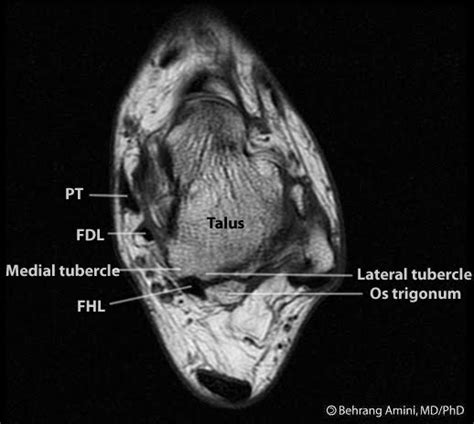 Roentgen Ray Reader: Os Trigonum Syndrome