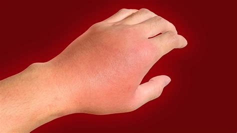 Cellulitis Treatment Services | Elitecare Emergency Hospital
