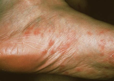 secondary syphilis