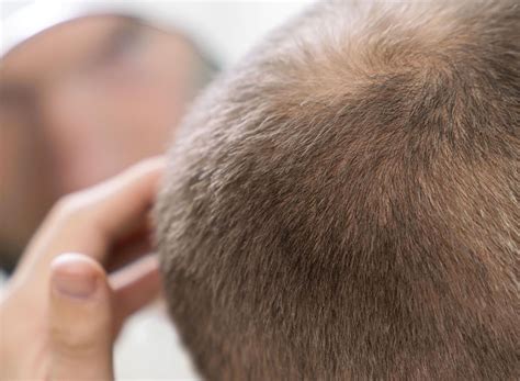 como quitar el dolor del cuero cabelludo  el cabello