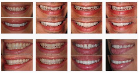 Teeth Veneers Before And After