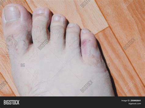 Broken Leg. Patient Image & Photo (Free Trial) | Bigstock