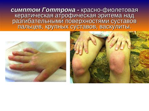 Системные заболевания соединительной ткани у детей - презентация онлайн