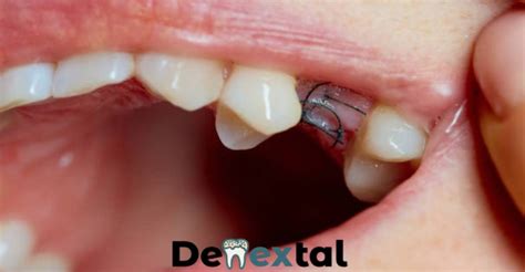 Wisdom Teeth Stitches - Everything You Need to Know - Denextal ...