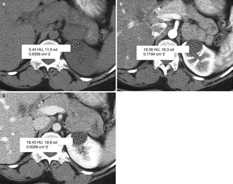 cystic disease radiology key