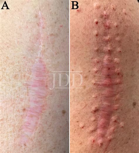Battling Neuropathic Scar Pain With Botulinum Toxin - Next Steps in