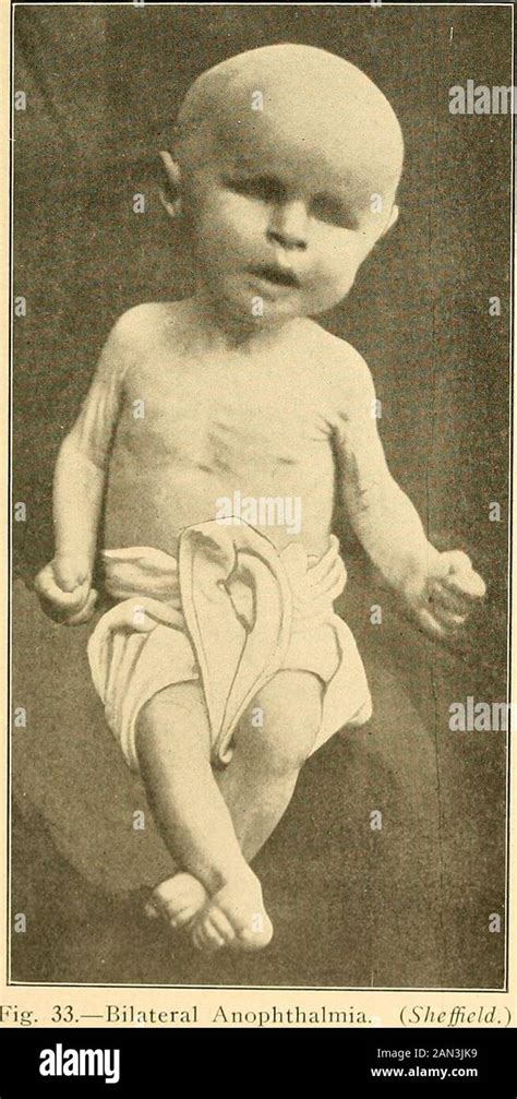 Cretinism hi-res stock photography and images - Alamy