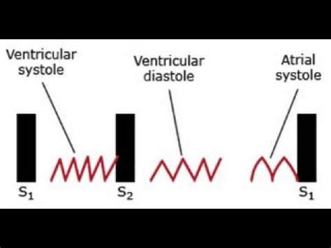 Pericardial Friction Rub Sound - slidesharetrick