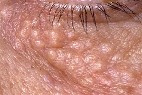 syringoma syringomas symptoms  treatment toronto