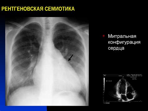 Сердце. Нормальная анатомия сердца - презентация онлайн