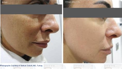 menghaluskan kulit wajah kasar  bertekstur coba treatment