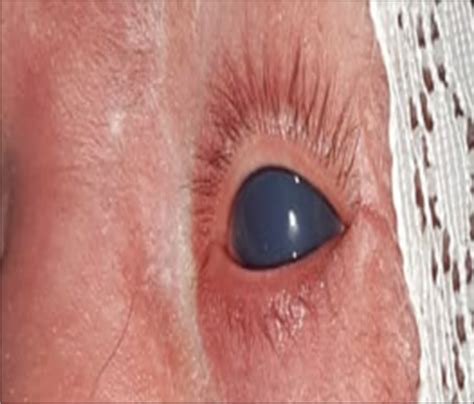 A case of cutis marmorata telangiectasia congenita - Wadia Journal of ...