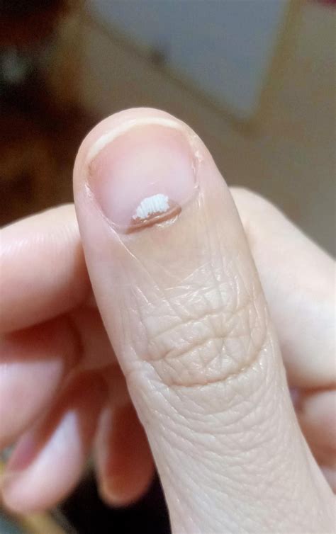 dark spot spreading   entire thumb nail cuticle  nail