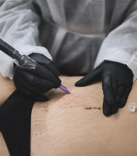 tattoo cover scar tummy tuck 10