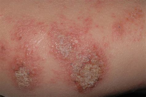 Cara roja y descamativa archivos - Dermatopharm