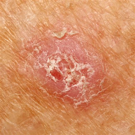 skin cancer skin cancer ballarat