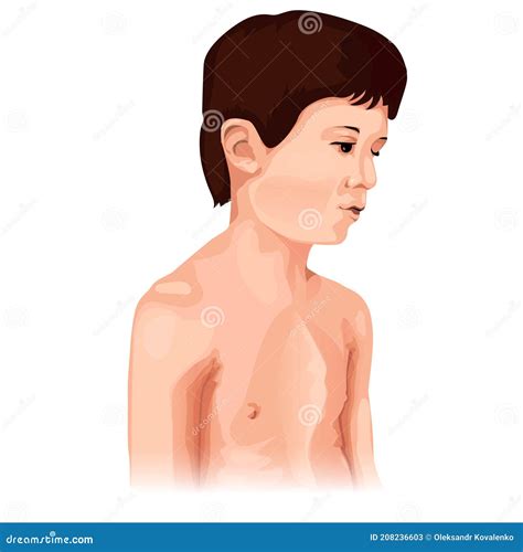 Chest Deformation Disorder Type. Pectus Carinatum. Marfan Syndrome
