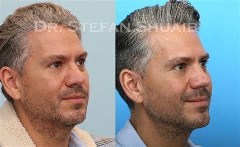 Neck Lift Archives | Dallas Facial Plastic Surgery Center