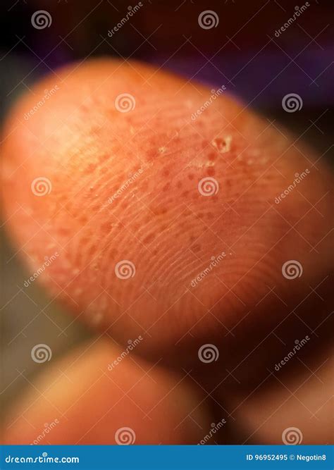 Yellow Bubbles Under Skin at Charles Rolle blog