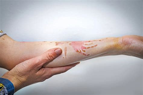 infected burns   seek treatment coastal