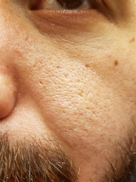 Unbelievable Blackhead Removal 2024: This One Weird Trick Works! Image 12