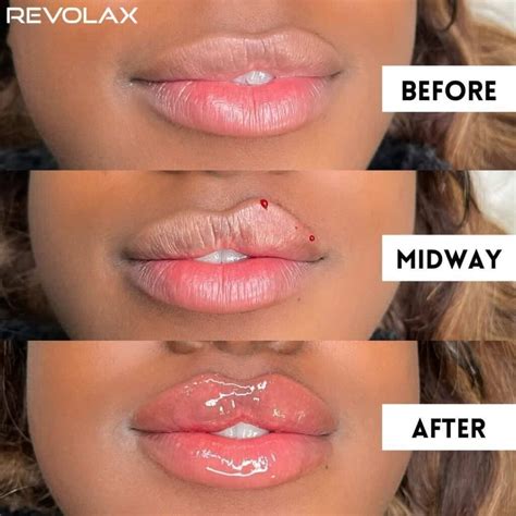 lip filler      results  daily glimmer