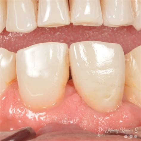 Case 51: Anterior Esthetic Zone Implants - Immediate