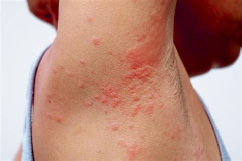 allergy rash of dermatitis problem. skin problem from drug allergy ...