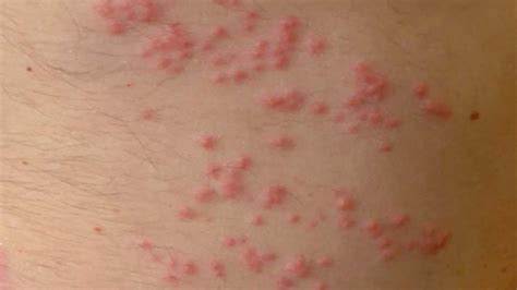Can’t-Miss Takeaways Of Info About How To Cure Sea Lice Bites - Postmary11