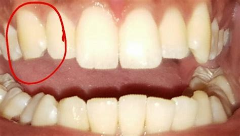 Chipped my canine tooth; what should I do? : Dentistry