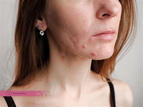 Severe Acne: Causes Treatment - RemoteDerm